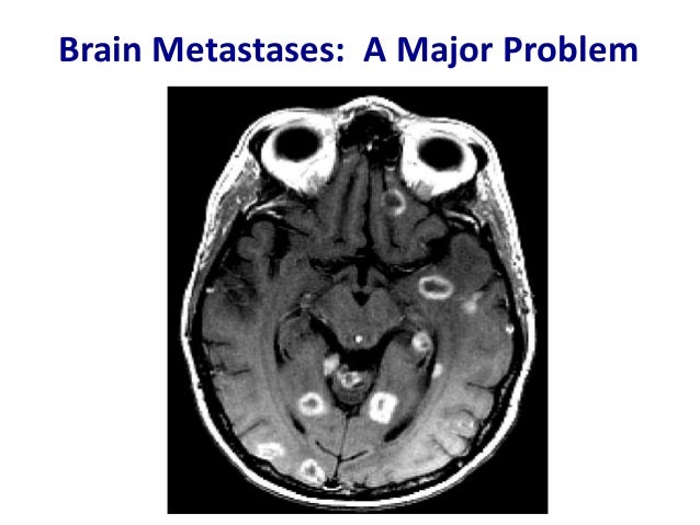 brain metastisis from breast cancer Brain metastisis from breast cancer